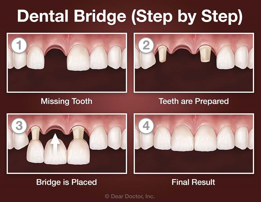 Dental Bridge Dr Ghorbani Aesthetic Restorative Specialist