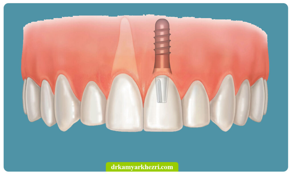 ایمپلنت دندان جلویی