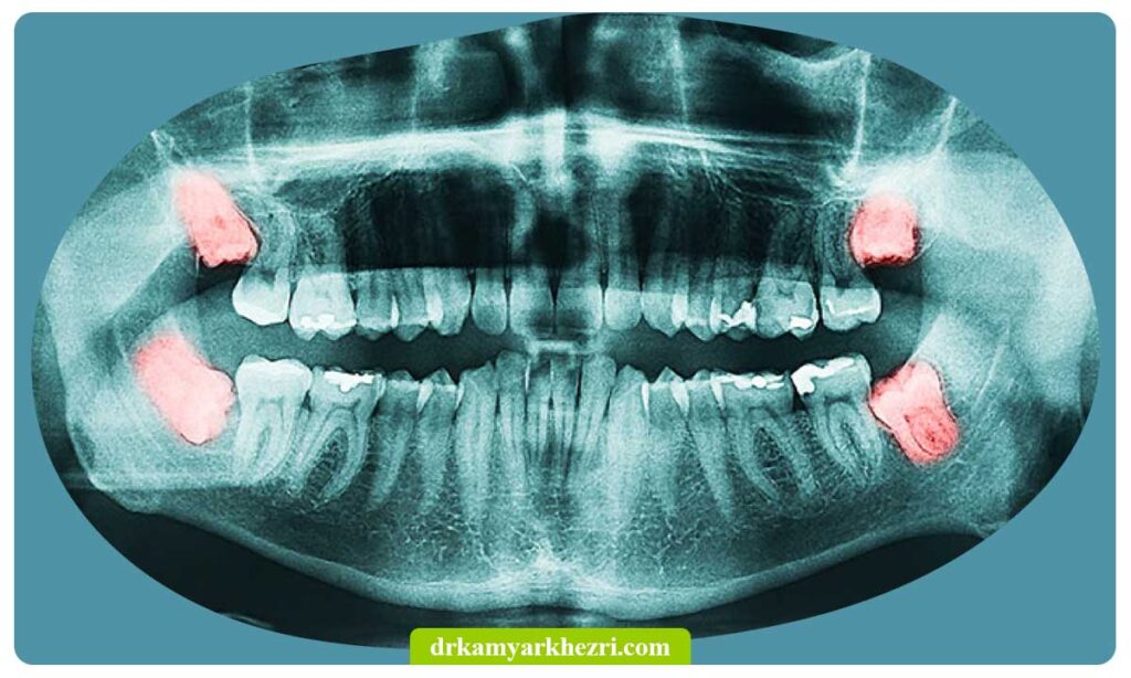 رشد دندان عقل و کج شدن سایر دندان ها