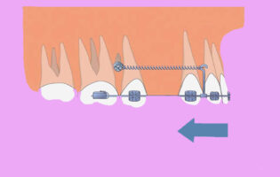 حرکت دندان ها در ارتودنسی