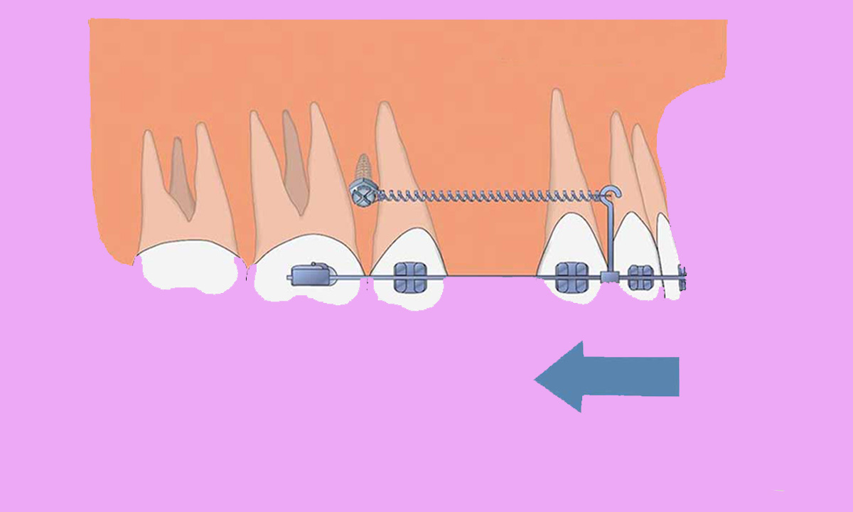 حرکت دندان ها در ارتودنسی